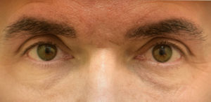 Eyebrow Hair Restoration
