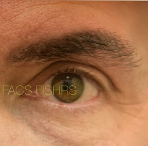 Eyebrow Hair Restoration