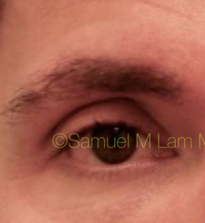 Eyebrow Hair Restoration