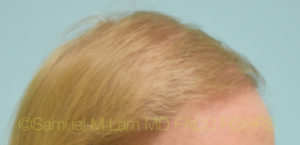 Transgender Hair Transplant