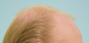 Transgender Hair Transplant
