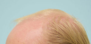 Transgender Hair Transplant
