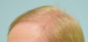 Transgender Hair Transplant