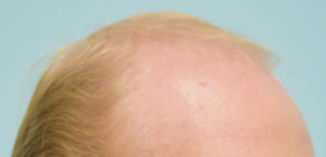 Transgender Hair Transplant