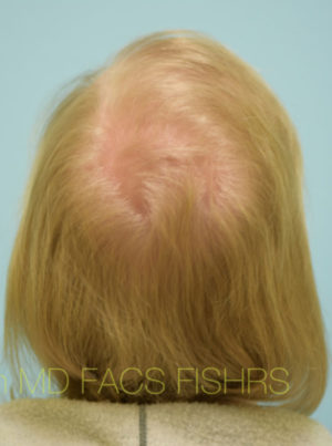 Transgender Hair Transplant