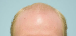 Transgender Hair Transplant