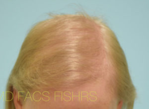 Transgender Hair Transplant