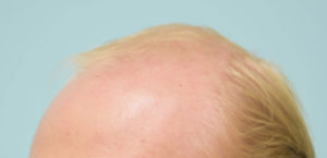 Transgender Hair Transplant