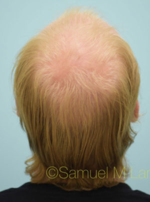 Transgender Hair Transplant