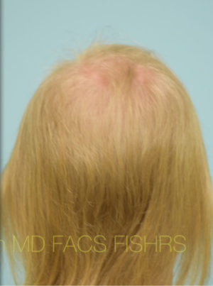 Transgender Hair Transplant