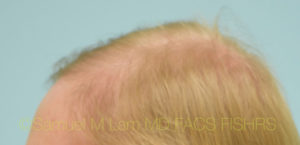 Transgender Hair Transplant