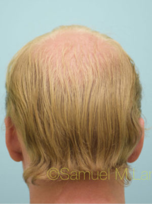 Transgender Hair Transplant