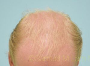 Transgender Hair Transplant