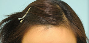 Asian Hair Transplant