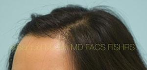 Asian Hair Transplant