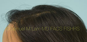 Asian Hair Transplant