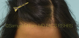 Asian Hair Transplant