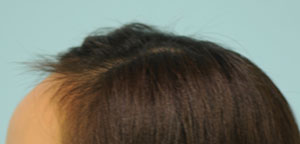 Asian Hair Transplant