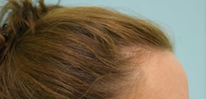 Female Hair Restoration