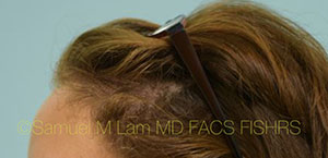 Female Hair Restoration