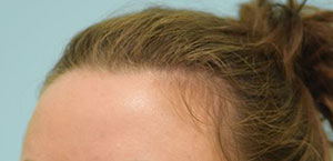 Female Hair Restoration