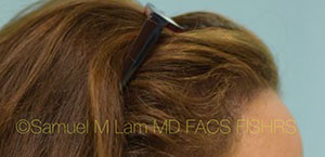 Female Hair Restoration