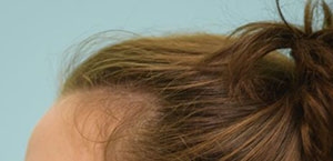Female Hair Restoration