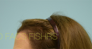 Female Hair Restoration