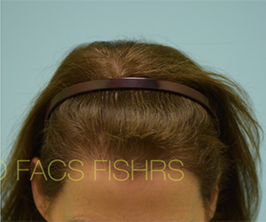 Female Hair Restoration