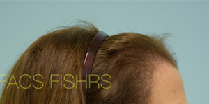 Female Hair Restoration