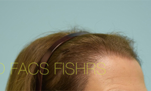Female Hair Restoration