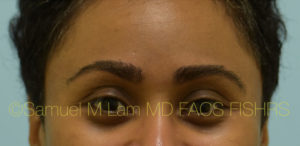 Eyebrow Hair Restoration