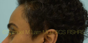 Eyebrow Hair Restoration