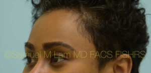 Eyebrow Hair Restoration