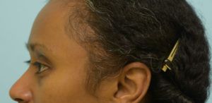 Eyebrow Hair Restoration