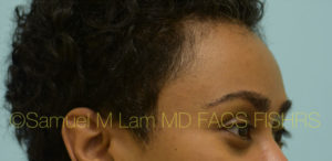 Eyebrow Hair Restoration