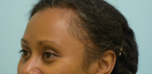 Eyebrow Hair Restoration