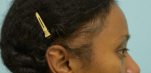 Eyebrow Hair Restoration