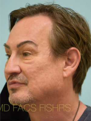 Eyebrow Hair Restoration