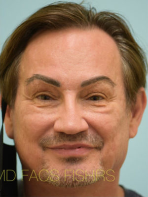 Eyebrow Hair Restoration