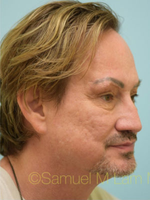 Eyebrow Hair Restoration