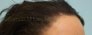 Female Hairline Lowering