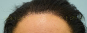 Female Hairline Lowering