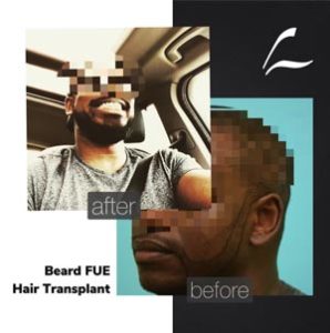 Hybrid FUE, Dallas TX