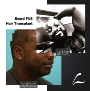 Hybrid FUE, Dallas TX
