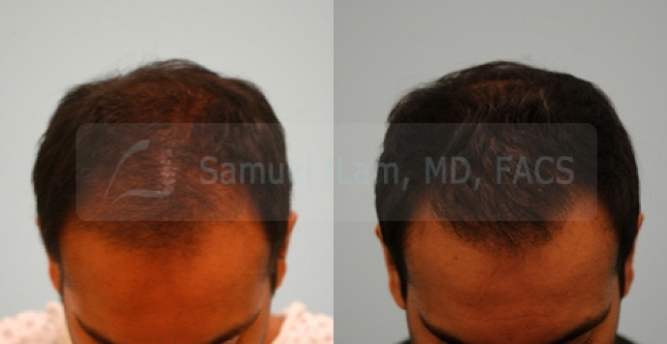 Dallas Hairline and Central Density Hair Restoration Before and After  Photos - Plano Plastic Surgery Photo Gallery - Dr. Samuel Lam20523 | Lam,  Sam ()