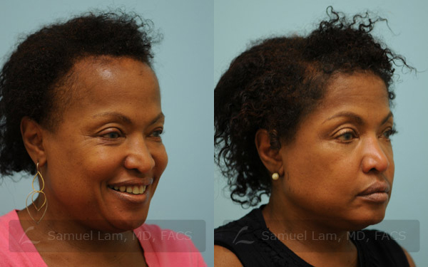 Dallas African Hair Transplant Before and After Photos - Plano Plastic  Surgery Photo Gallery - Dr. Samuel Lam21985 | Lam, Sam ()