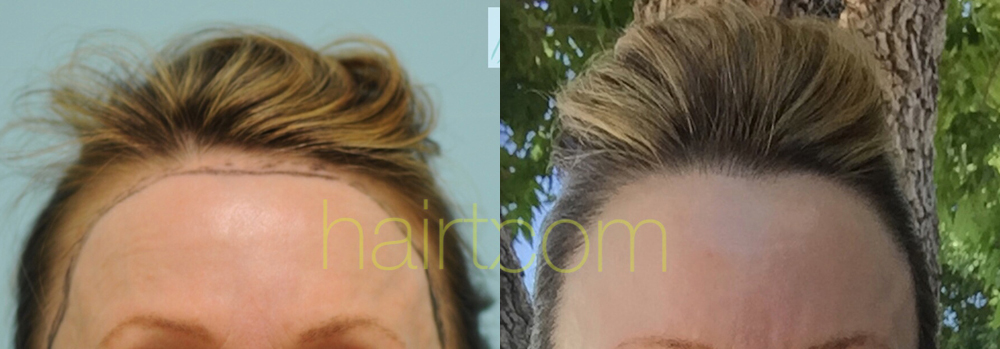 Dallas Female Hairline Lowering Before and After Photos - Plano Plastic  Surgery Photo Gallery - Dr. Samuel Lam23050 | Lam, Sam ()