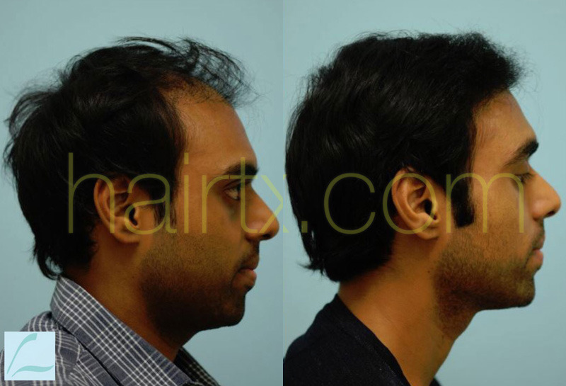 Dallas Hairline and Central Density Hair Restoration Before and After  Photos - Plano Plastic Surgery Photo Gallery - Dr. Samuel LamIndian Hair  Restoration Archives | Lam, Sam ()