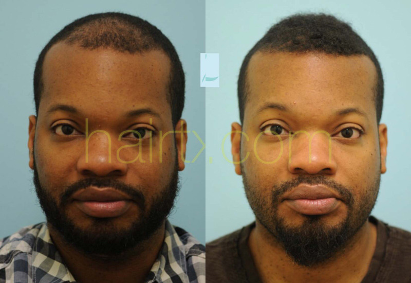 Dallas Hairline and Central Density Hair Restoration Before and After  Photos - Plano Plastic Surgery Photo Gallery - Dr. Samuel Lam23477 | Lam,  Sam ()